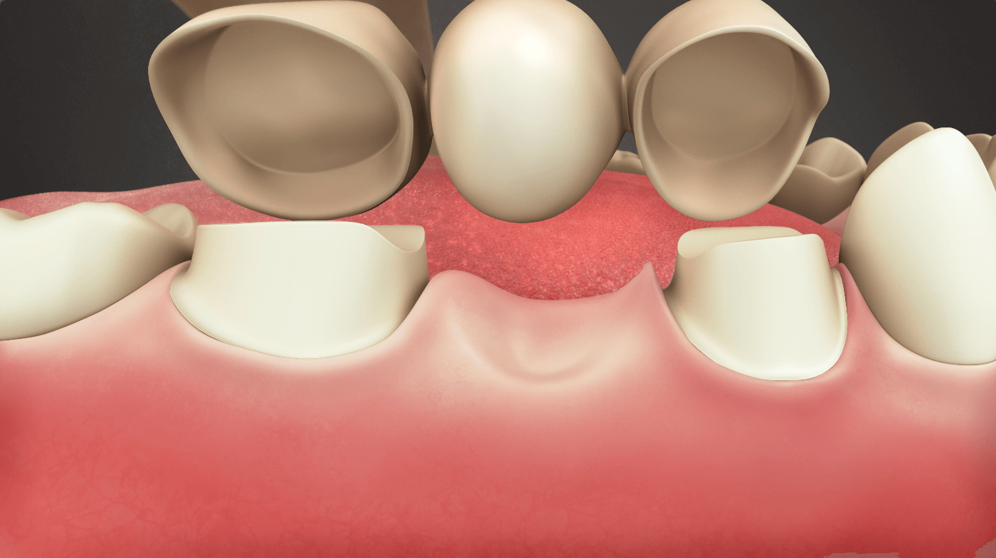 Bridge to Replace Missing Tooth