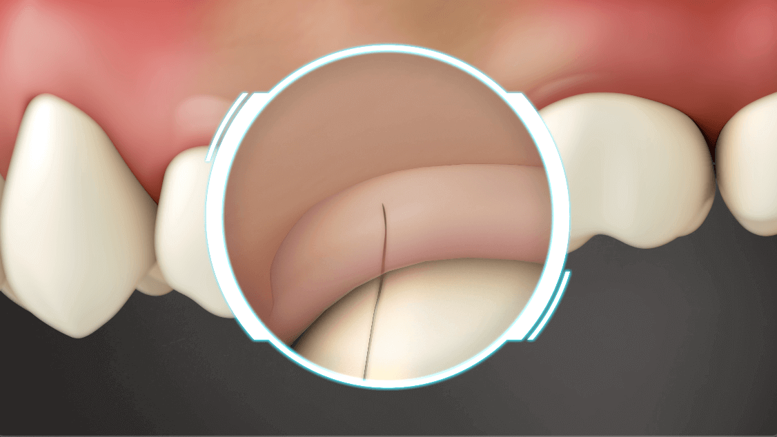 Crown Lengthening Before a Restoration