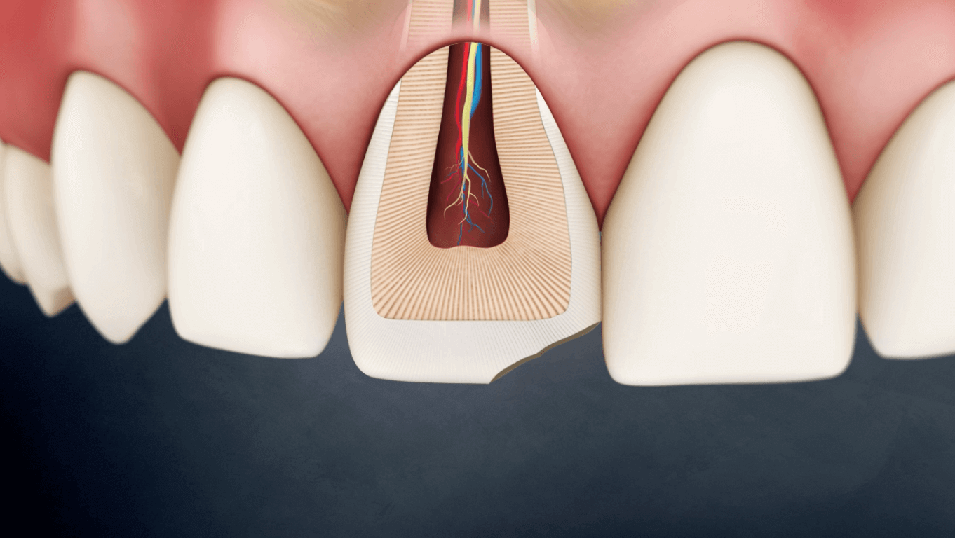 Trauma Enamel Fracture