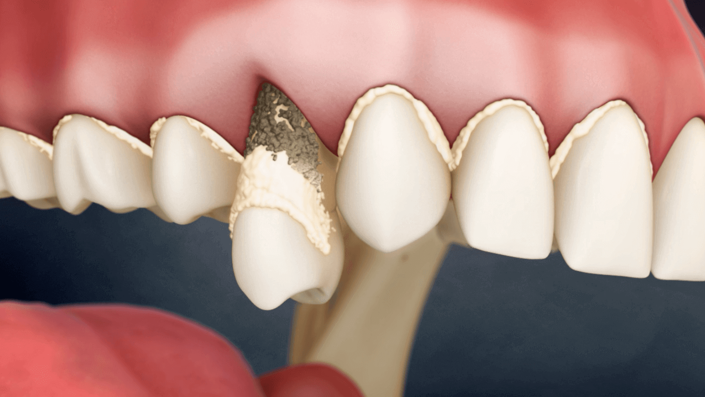 Extraction Plaque and Tartar