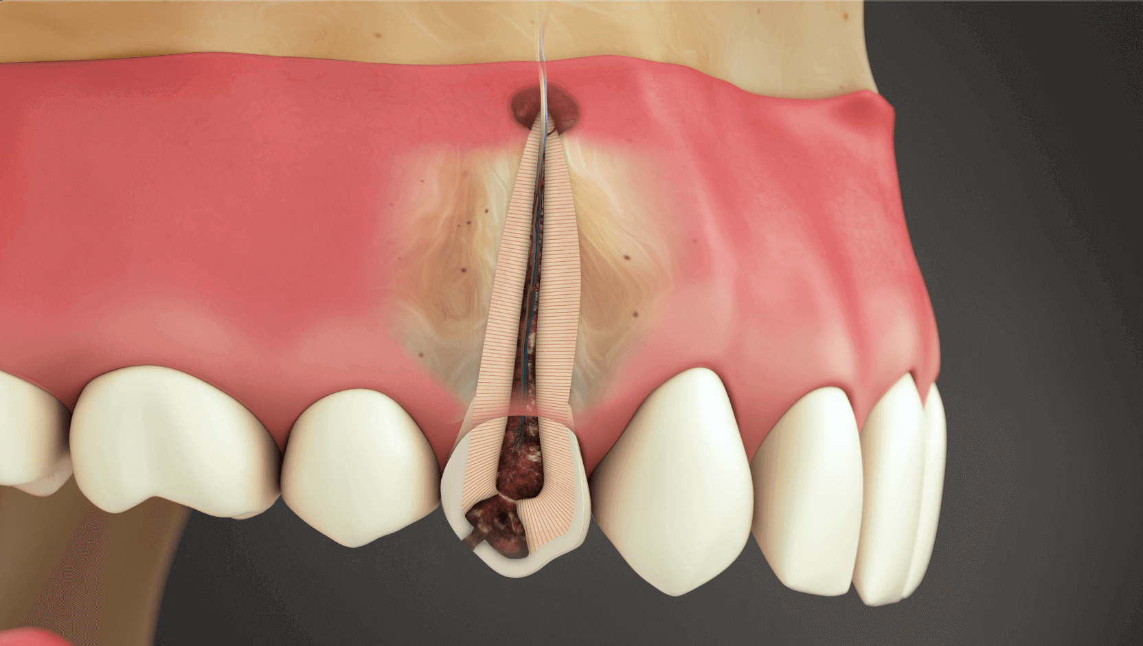 Extraction Unchecked Decay