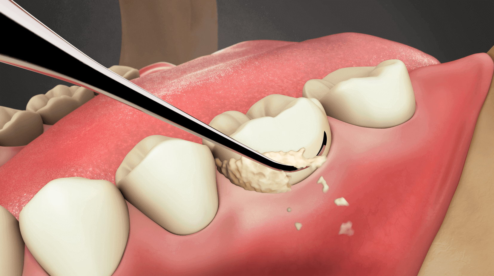 Hand Scaling and Polishing