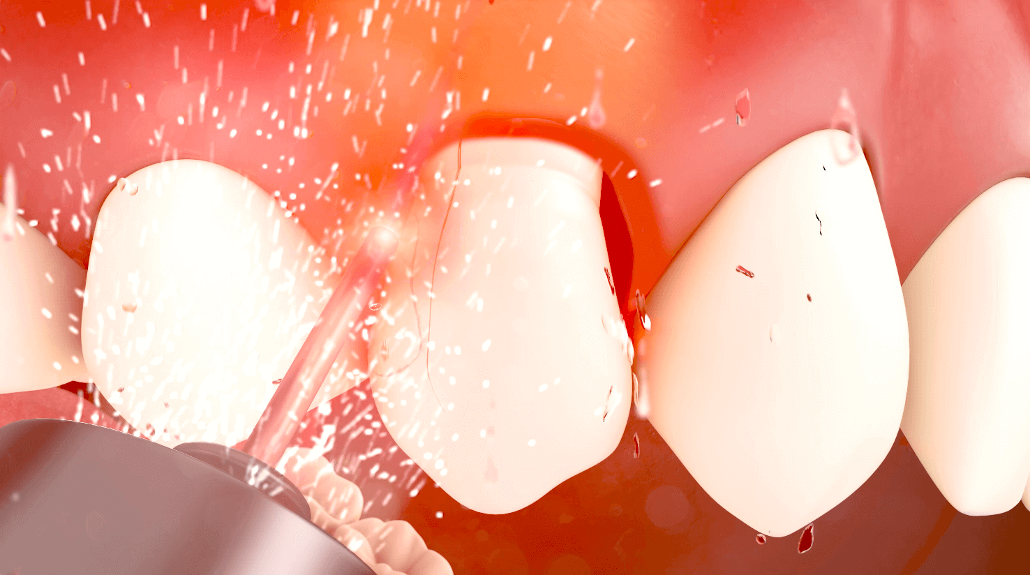 Hard Tissue Laser Crown Lengthening