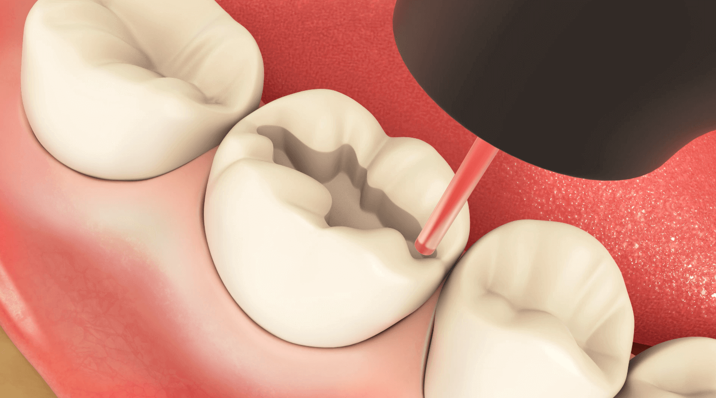 Hard Tissue Laser Decay Removal