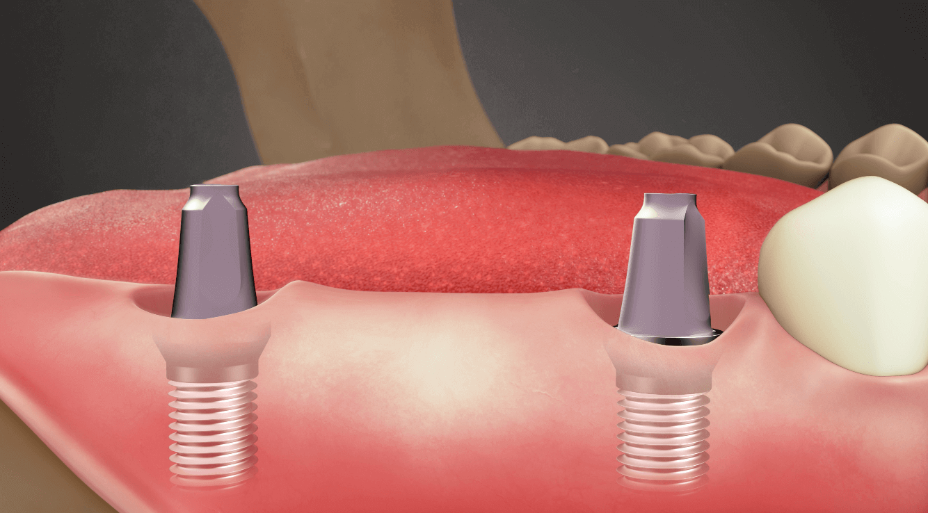 Implant Supported Bridge