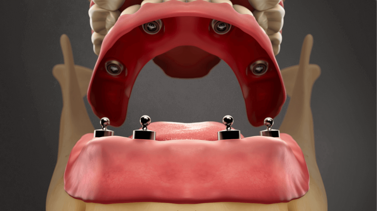 Implant Supported Lower Denture
