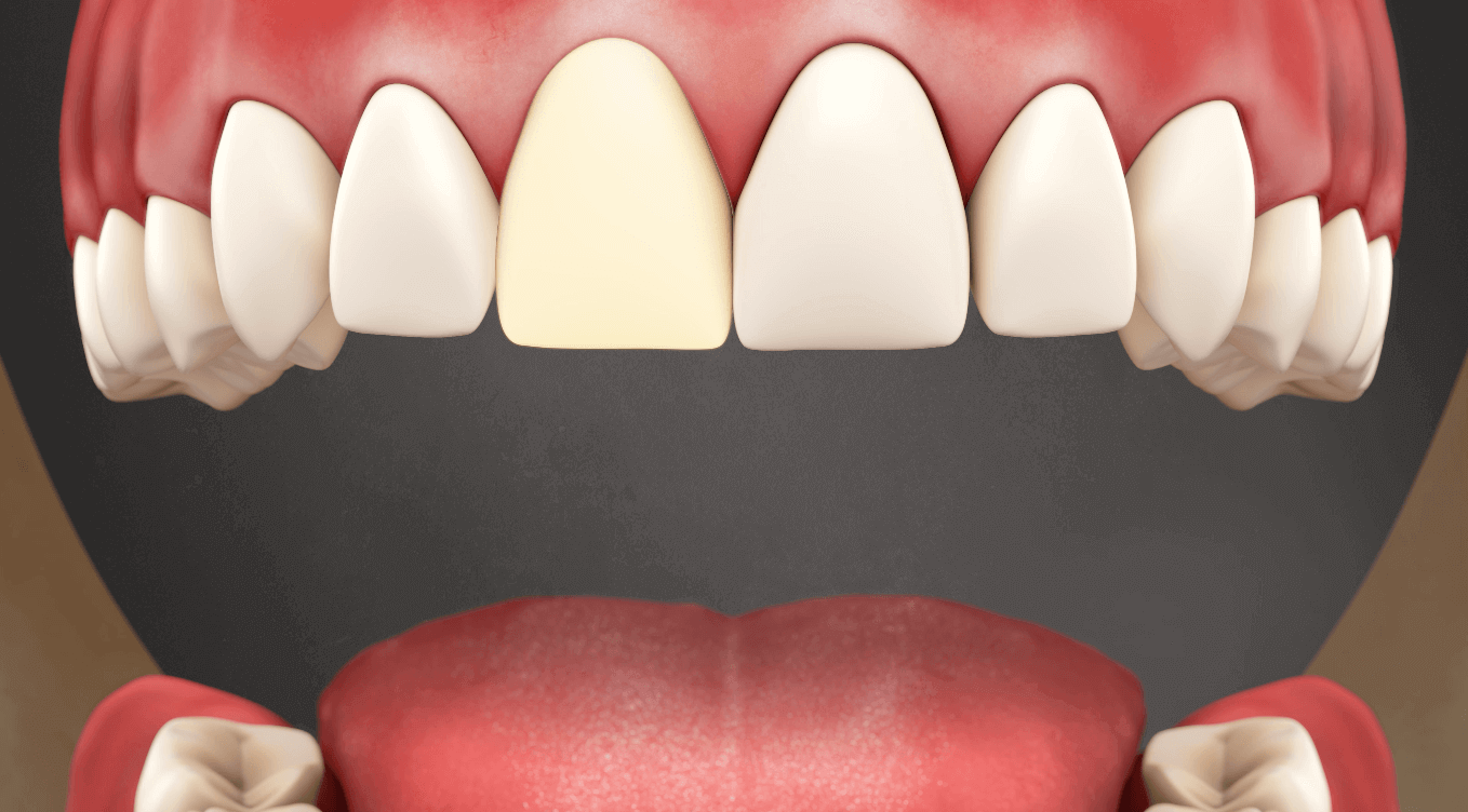 Post-Operation Instructions with Temporary Veneers