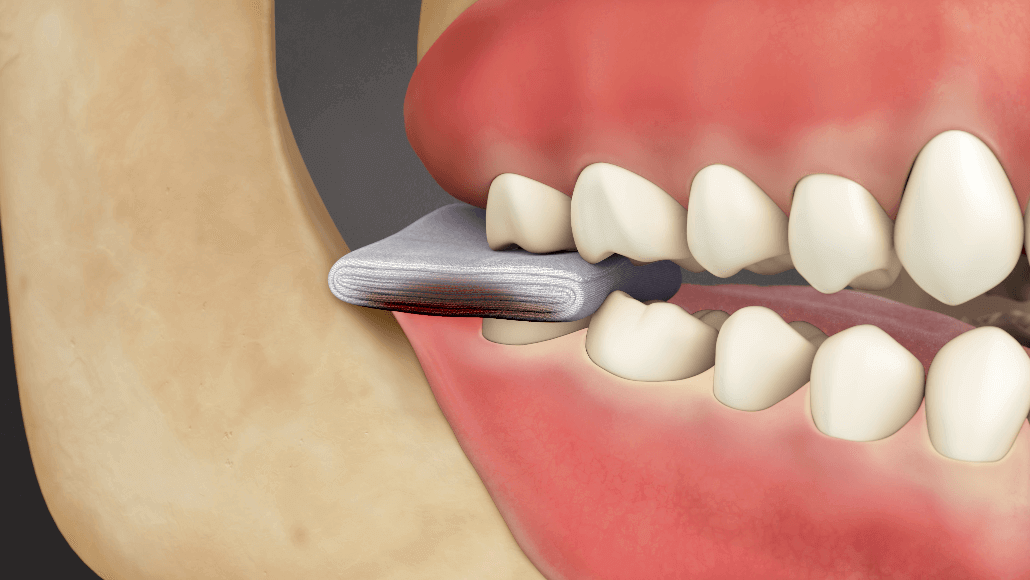 Post-Operation Wisdom Tooth Extraction