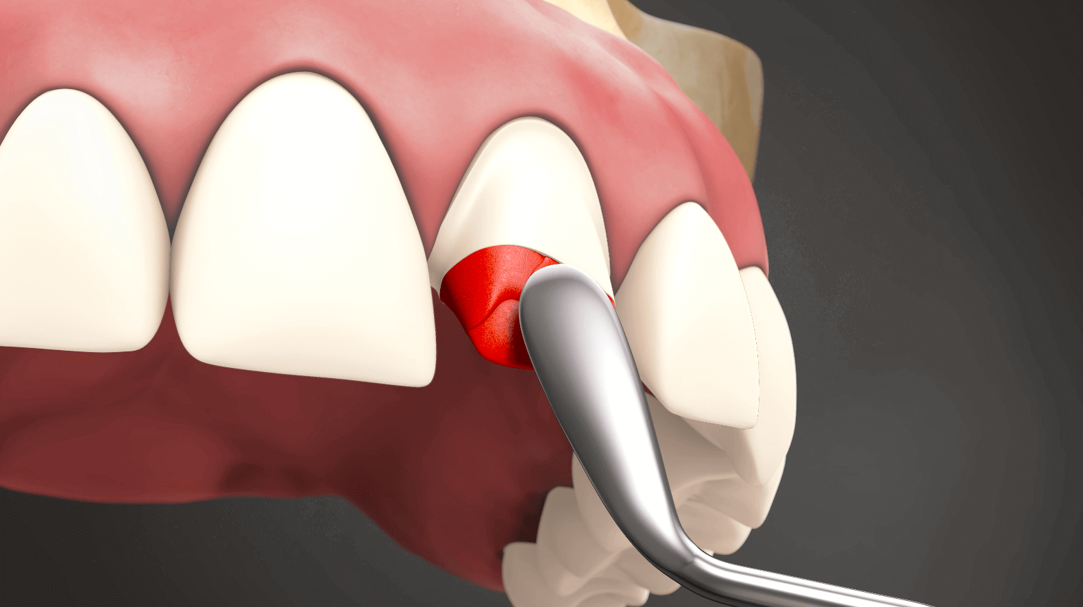 Post and Core (Lab Processed)
