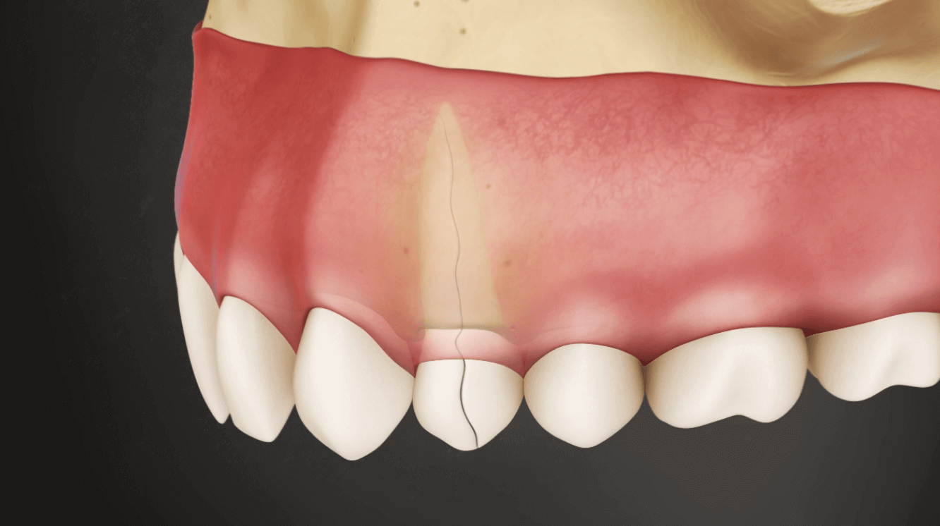 Preservation of Bone Loss