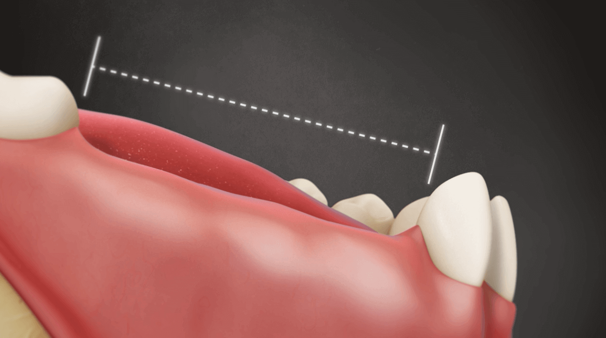 Replacement Options Missing Teeth