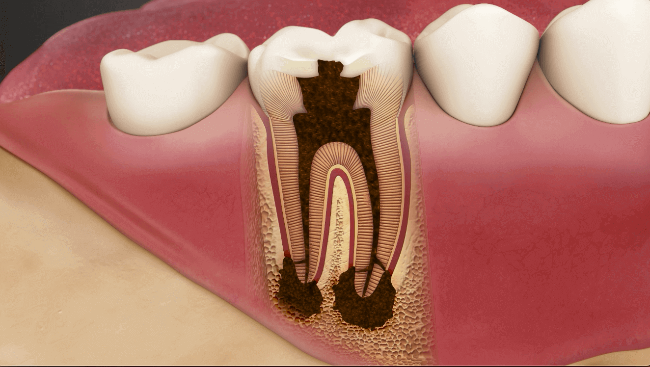 Root Canal Treatment