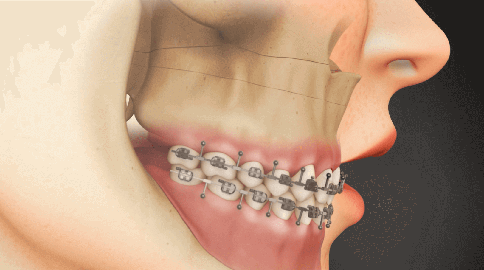 What is Intermaxillary Fixation