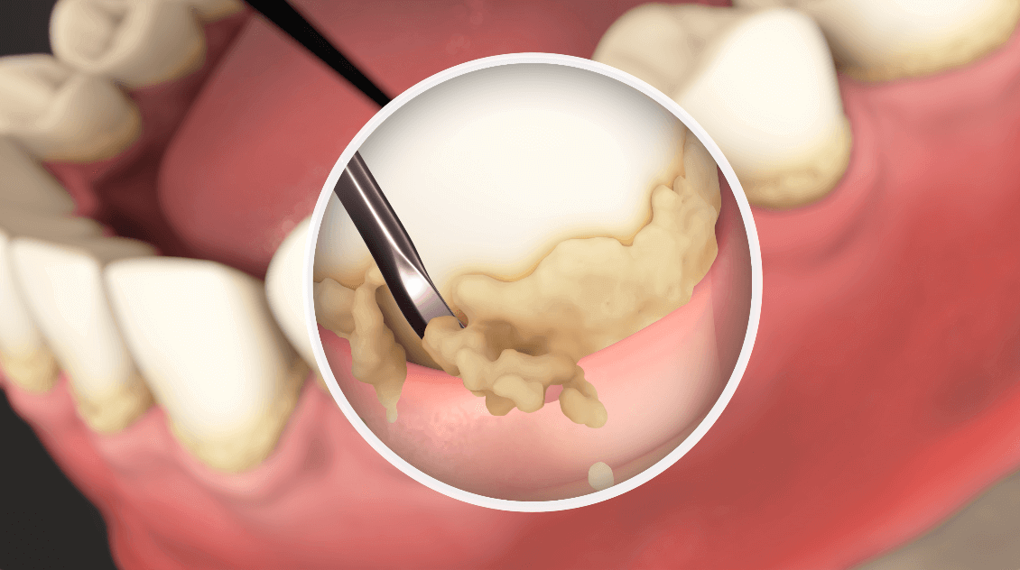 Deep Scaling & Root Planing