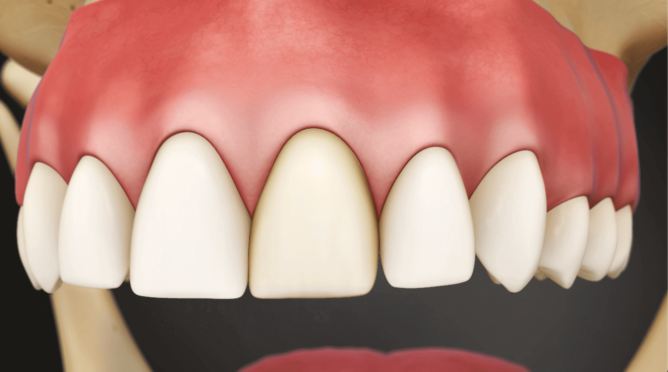 Porcelain Crown No Metal Showing