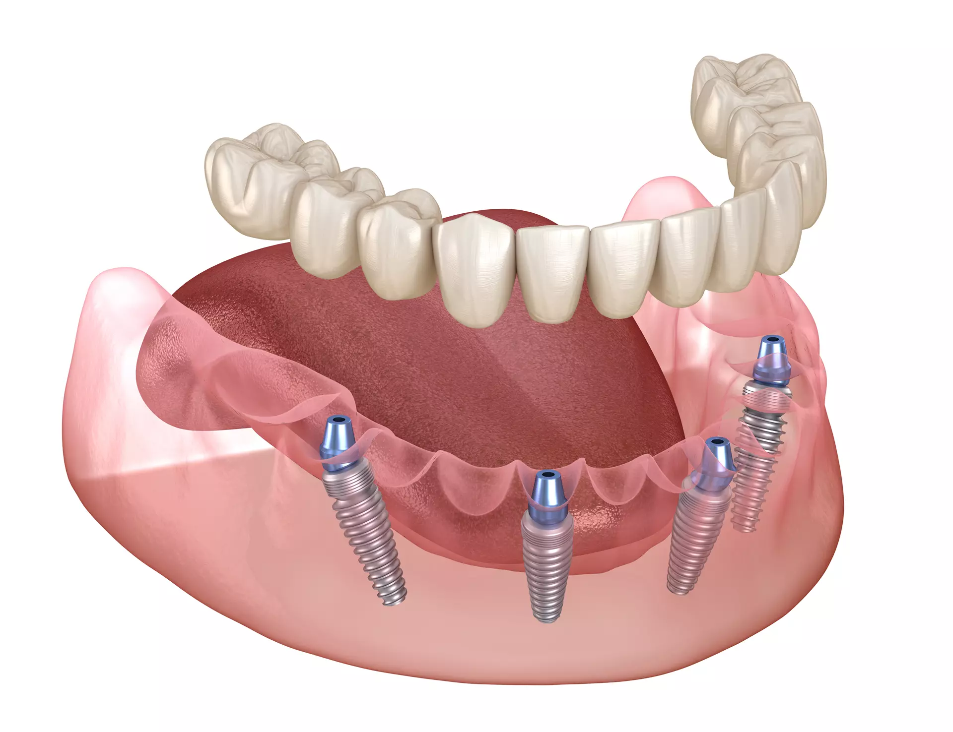 3D model of All-on-4 dental implants