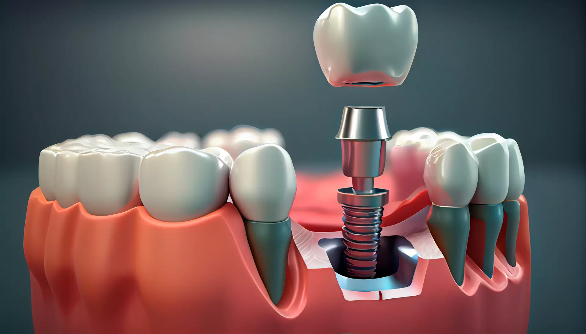 All-on-X dental implants procedure
