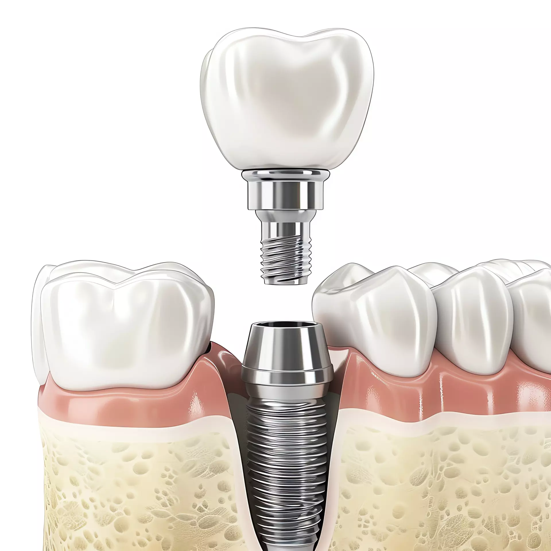 Dental implant procedure illustration